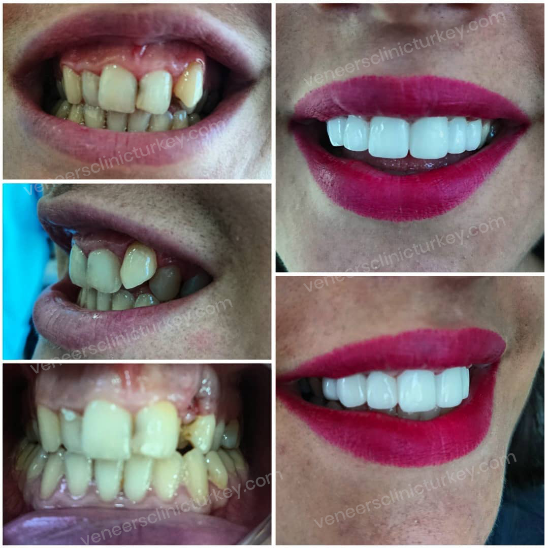 Before and After Image 1 - Veneers Clinic Turkey